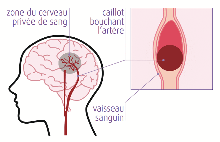 AVC Ischémique ou infarctus cérébral