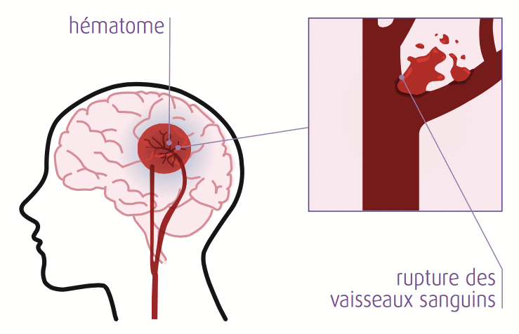 AVC hémorragique