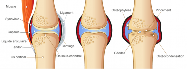 Qu Est Ce Que L Arthrose Et Comment La Traiter Institut Amelis