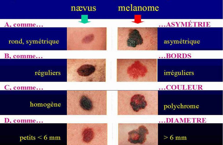 Cancer de la peau : Définition, Symptômes & Traitements - Institut Amelis