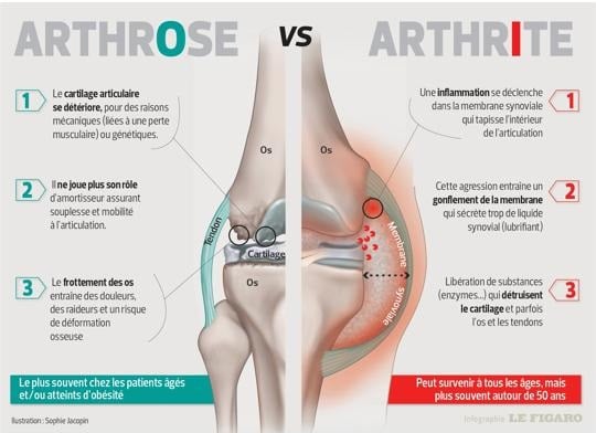 Infographie présentant les différences de symptômes entre l'arthrose et l'arthrite