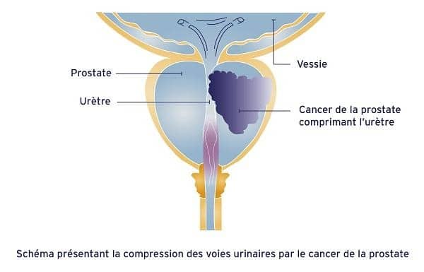 Compression des voies urinaires par le cancer de la prostate