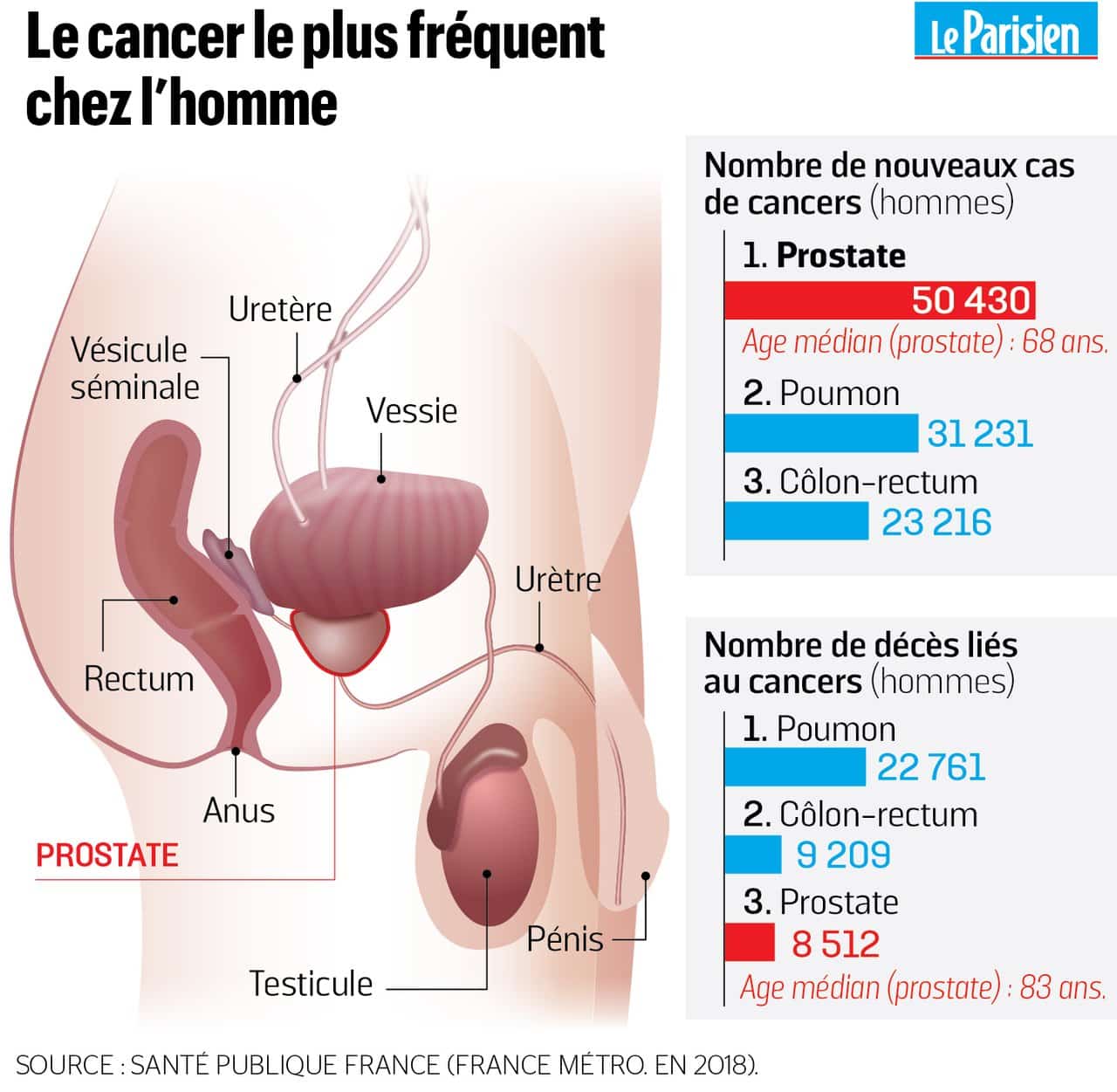 prostatite symptômes