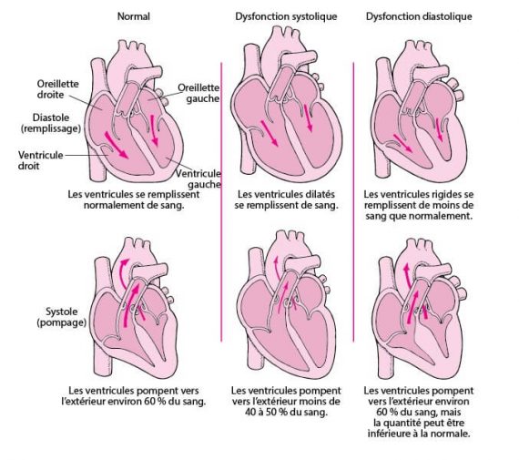 Insuffisance Cardiaque: Causes, Symptômes et Traitements ...