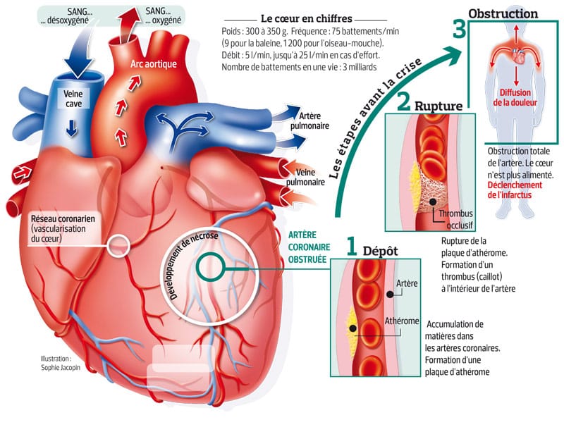 Infographie présentant les étapes avant la crise cardiaque ou l'infarctus du myocarde