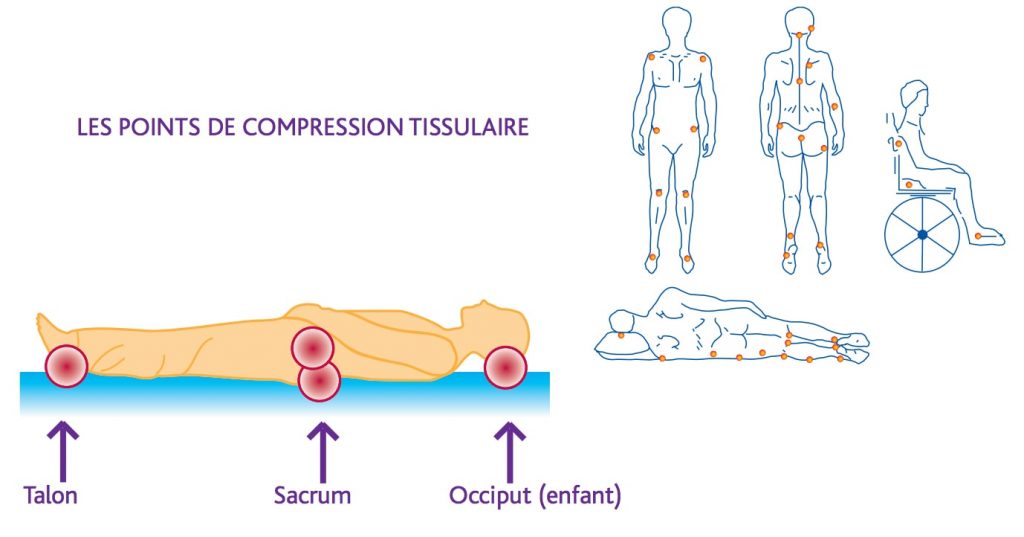 Infographie représentatant les différents points de compression tissulaire sur lesquels une escarre peut se former