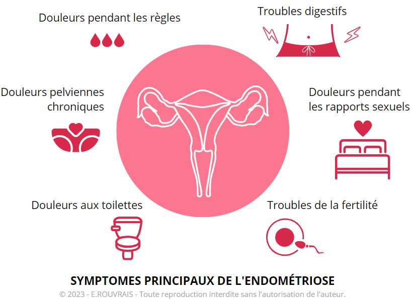 Infographie présentant les principaux symptômes de l'endométriose