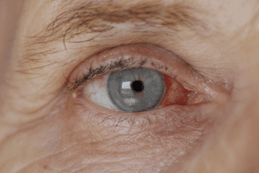 qu'est-ce que la cataracte et quels sont les traitements possibles