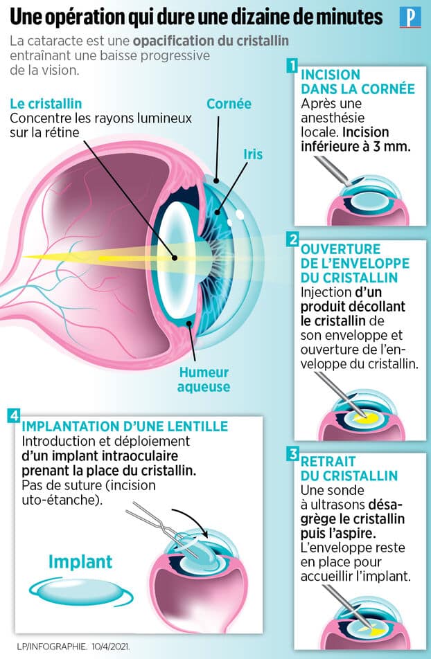 infographie expliquant comment se déroule une opération de la cataracte 