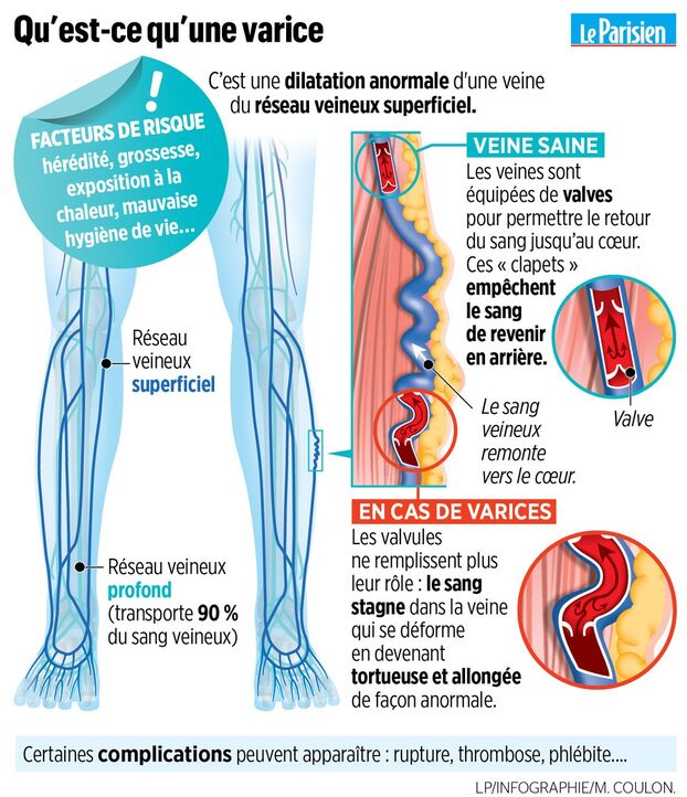 Infographie présentant ce qu'est une varice